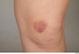 Aera knee scab 0002.jpg